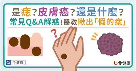 紅色的痣代表什麼|是痣？皮膚癌？還是什麼？常見Q&A解惑！醫教揪出「。